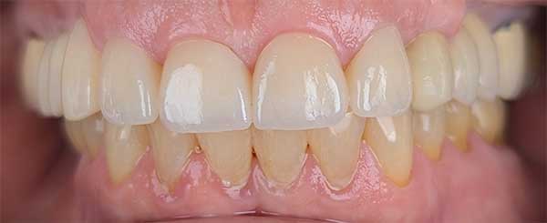 before and after case 1 - after