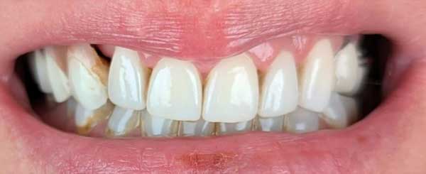 before and after case 3 - after